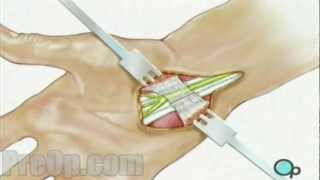 Carpal Tunnel Syndrome Treatment Options [upl. by Samaria]