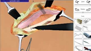 Hernia Repair  Open Surgery Simulation [upl. by Yregerg]