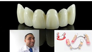 Prótesis Dental Removible o Fija Como son Cual es la diferencia [upl. by Joanne]