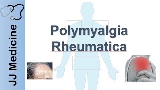 What is rheumatoid arthritis [upl. by Papert]