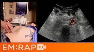 Secrets of Carotid Ultrasound [upl. by Myra]