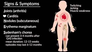 Rheumatoid Arthritis RA vs Osteoarthritis OA  Rheumatology Series [upl. by Enomyar]