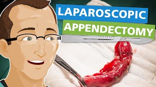 Laparoscopic Appendectomy [upl. by Belden423]