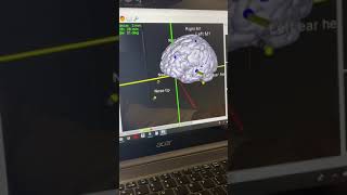 TMS for Tinnitus treatment [upl. by Nylsor]