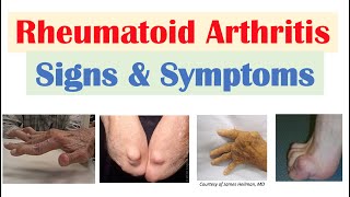 Acute Rheumatic Fever by E Rusingiza  OPENPediatrics [upl. by Nofets]