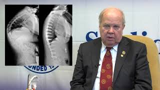 SRS Patient Video Kyphosis  George H Thompson MD [upl. by Royo]