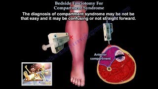 Bedside Fasciotomy For Compartment Syndrome  Everything You Need To Know  Dr Nabil Ebraheim [upl. by Clarhe]