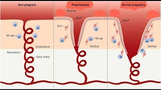 Preeclampsia Pathophysiology [upl. by Elagibba]