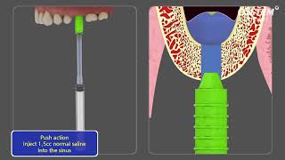 CAS KIT Crestal Approach  Sinus KIT [upl. by Mun]