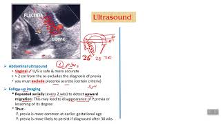 Antepartum hemorrhage  part 3 [upl. by Hulbert]