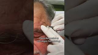 Favre–Racouchot 🎡 Round 13 with Dr HL Greenberg at Las Vegas Dermatology [upl. by Burnaby]