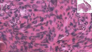 Meningioma  Histopathology [upl. by Eneri]