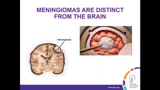 WEBINAR Treatment Strategies for Meningioma [upl. by Fante]