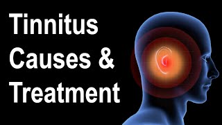 What is Tinnitus Causes amp Treatment Strategies [upl. by Becket]