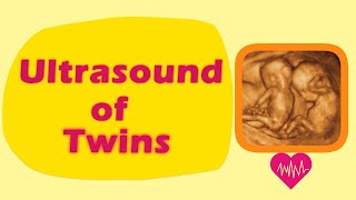 Sonography of Twins [upl. by Atig862]