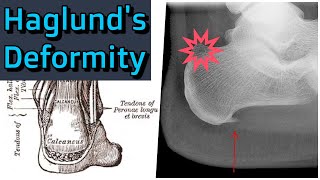 Haglunds Deformity [upl. by Redla]