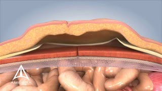 Ventral Hernia Repair  3D Medical Animation [upl. by Pedro]