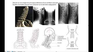 Radiographies du rachis cervical [upl. by Hoag755]